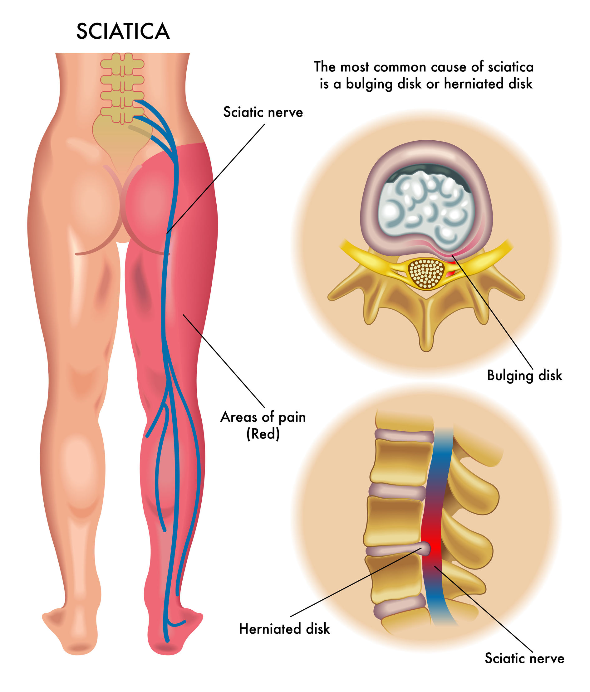 Sciatica Treatment  Ravenswood Chiropractic in Chicago