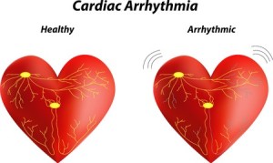cardiac arrhythmia