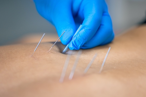 Dry needling treatment in progress, representing targeted care for muscle tension, pain relief, and recovery
